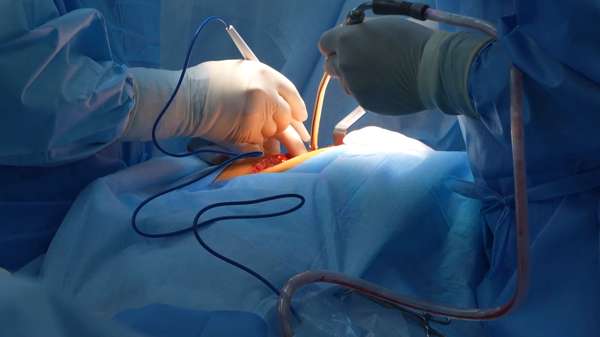 رکورد عمل قلب در بیمارستان رضوی شکسته شد