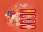 درمان بیماران مبتلا به تنگی عروق قلبی با جدیدترین تکنیک‌های آنژیوپلاستی در بیمارستان رضوی